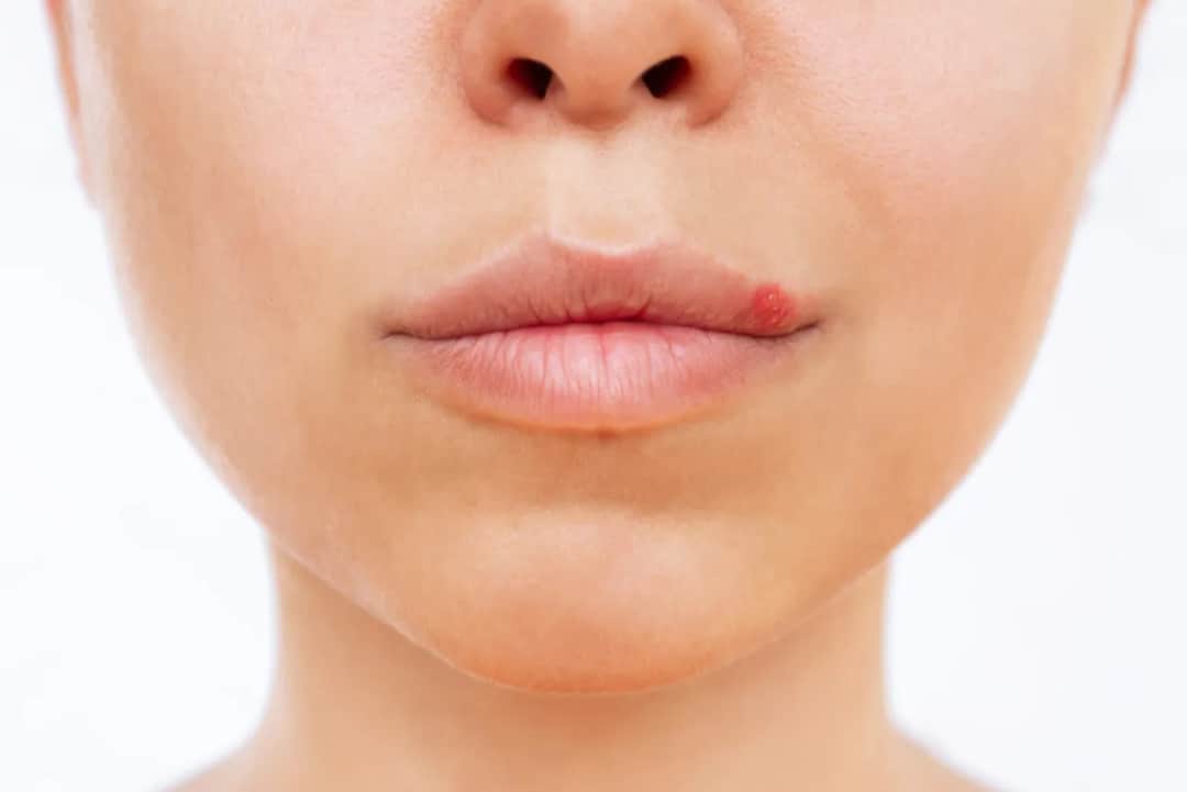 Jak zapobiec opryszczce: skuteczne sposoby na unikanie nawrotów